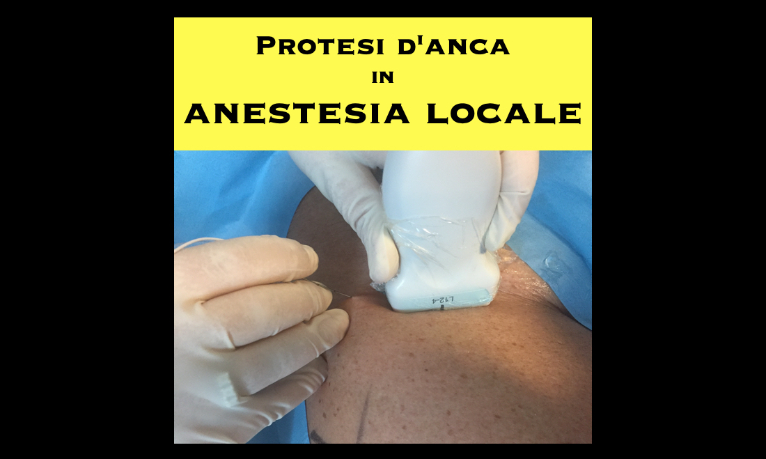 Protesi d'anca in anestesia locale - Dott. Andrea Blasi